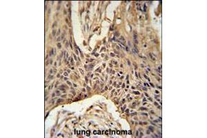 LPPR4 Antibody immunohistochemistry analysis in formalin fixed and paraffin embedded human lung carcinoma followed by peroxidase conjugation of the secondary antibody and DAB staining. (LPPR4 抗体  (C-Term))