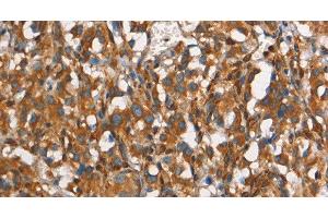 Immunohistochemistry of paraffin-embedded Human thyroid cancer tissue using CEACAM3 Polyclonal Antibody at dilution 1:30 (CEACAM3 抗体)