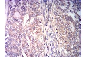 Immunohistochemical analysis of paraffin-embedded cervical cancer tissues using CCNE1 mouse mAb with DAB staining. (Cyclin E1 抗体  (AA 1-100))