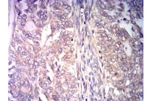Immunohistochemical analysis of paraffin-embedded cervical cancer tissues using CCNE1 mouse mAb with DAB staining.