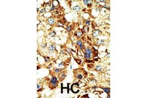 Formalin-fixed and paraffin-embedded human hepatocellular carcinoma tissue reacted with the primary antibody DNMT3A polyclonal antibody  , which was peroxidase-conjugated to the secondary antibody, followed by DAB staining. (DNMT3A 抗体  (Internal Region))