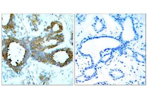 Immunohistochemical analysis of paraffin-embedded human breast carcinoma tissue, using PAK1/PAK2/PAK3 (Phospho-Thr423/Thr402/Thr421) antibody (E011165). (PAK1/2/3 抗体  (pThr402, pThr421, pThr423))