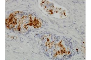 Immunoperoxidase of monoclonal antibody to PIM1 on formalin-fixed paraffin-embedded human prostate. (PIM1 抗体  (AA 1-313))