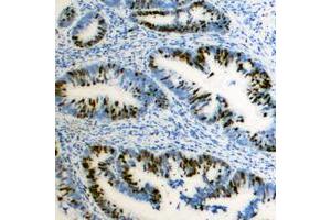 Immunohistochemical analysis of ZEB2 staining in human colon cancer formalin fixed paraffin embedded tissue section. (ZEB2 抗体  (N-Term))