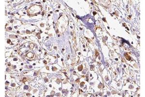 ABIN6279467 at 1/100 staining Human breast cancer tissue by IHC-P. (RABIF 抗体  (N-Term))