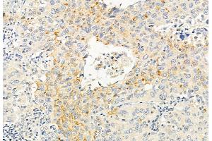 ABIN6265621 and ABIN6272881 at 1/100 staining Human lung cancer by IHC-P.