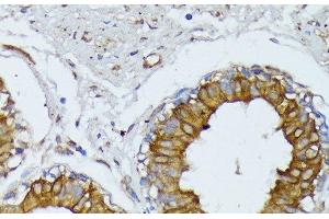 Immunohistochemistry of paraffin-embedded Human mammary cancer using WNT1 Polyclonal Antibody at dilution of 1:100 (40x lens).