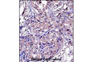 P11 Antibody (C-term) ((ABIN657651 and ABIN2846646))iunohistochemistry analysis in formalin fixed and paraffin embedded human breast carcinoma followed by peroxidase conjugation of the secondary antibody and DAB staining. (MMP11 抗体  (C-Term))