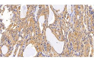 Detection of LAMP2 in Human Thyroid cancer Tissue using Polyclonal Antibody to Lysosomal Associated Membrane Protein 2 (LAMP2) (LAMP2 抗体  (AA 193-375))