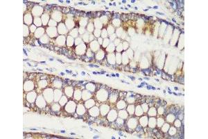 Immunohistochemistry of paraffin-embedded Human colon carcinoma using TOM20 Polyclonal Antibody at dilution of 1:100 (40x lens). (TOMM20 抗体)