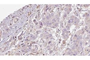 ABIN6273928 at 1/100 staining Human liver cancer tissue by IHC-P. (GPR161 抗体  (Internal Region))