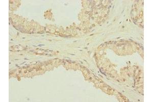 Immunohistochemistry of paraffin-embedded human prostate cancer using ABIN7168604 at dilution of 1:100 (SCAND1 抗体  (AA 1-179))