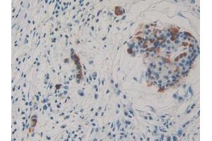 DAB staining on IHC-P; Samples: Human Pancreatic cancer Tissue (THBS3 抗体  (AA 670-921))