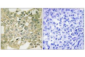 Immunohistochemistry analysis of paraffin-embedded human breast carcinoma tissue using MYT1 (Phospho-Ser83) antibody. (MYT1 抗体  (pSer83))