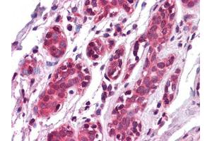 Immunohistochemical analysis of paraffin-embedded human Breast tissues using EPHA7 mouse mAb
