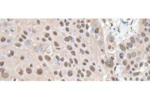 Immunohistochemistry of paraffin-embedded Human esophagus cancer tissue using SMC1A Polyclonal Antibody at dilution of 1:30(x200) (SMC1A 抗体)