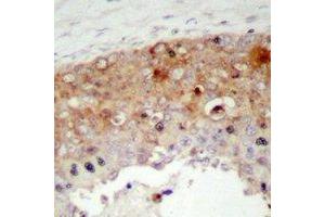 Immunohistochemical analysis of SHCA (pY427) staining in human prostate cancer formalin fixed paraffin embedded tissue section. (SHC1 抗体  (pTyr427))
