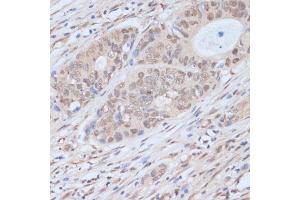 Immunohistochemistry of paraffin-embedded human colon carcinoma using CDK9 antibody (ABIN6129241, ABIN6138331, ABIN6138332 and ABIN6214015) at dilution of 1:100 (40x lens). (CDK9 抗体  (AA 153-372))