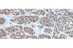 Immunohistochemistry of paraffin-embedded Human esophagus cancer tissue using RPF2 Polyclonal Antibody at dilution of 1:40(x200) (RPF2 抗体)