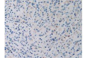 IHC-P analysis of Human Prostate Gland Cancer Tissue, with DAB staining. (DDX58 抗体  (AA 550-776))
