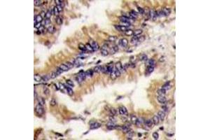 Formalin-fixed and paraffin-embedded human lung carcinoma tissue reacted with MAPK1 Antibody (Center) , which was peroxidase-conjugated to the secondary antibody, followed by DAB staining. (ERK2 抗体  (Middle Region))