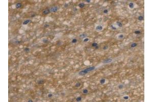 IHC-P analysis of Human Glioma Tissue, with DAB staining. (Aquaporin 4 抗体  (AA 178-317))
