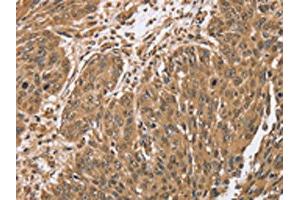 The image on the left is immunohistochemistry of paraffin-embedded Human lung cancer tissue using ABIN7192064(PTPN20A/PTPN20B Antibody) at dilution 1/40, on the right is treated with synthetic peptide. (PTPN2 抗体)