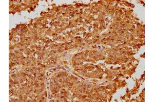 IHC image of ABIN7164990 diluted at 1:100 and staining in paraffin-embedded human cervical cancer performed on a Leica BondTM system. (PSMB8 抗体  (AA 176-276))