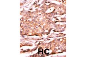 Formalin-fixed and paraffin-embedded human hepatocellular carcinoma tissue reacted with RAD9A (phospho S272) polyclonal antibody  which was peroxidase-conjugated to the secondary antibody followed by AEC staining.