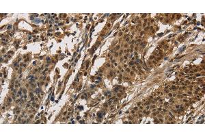 Immunohistochemistry of paraffin-embedded Human gasrtic cancer tissue using CCAR1 Polyclonal Antibody at dilution 1:40 (CCAR1 抗体)