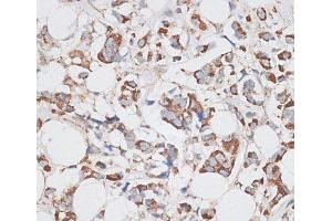 Immunohistochemistry of paraffin-embedded Human breast cancer using KIF14 Polyclonal Antibody at dilution of 1:100 (40x lens). (KIF14 抗体)