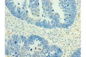 Immunohistochemistry of paraffin-embedded human ovarian cancer using ABIN7160504 at dilution of 1:100 (MEF2C 抗体  (AA 170-380))