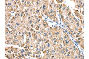 The image on the left is immunohistochemistry of paraffin-embedded Human liver cancer tissue using ABIN7191329(LTB4R2 Antibody) at dilution 1/20, on the right is treated with synthetic peptide. (LTB4R2 抗体)