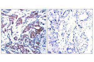 Immunohistochemical analysis of paraffin-embedded human breast carcinoma tissue using c-Jun(Phospho-Ser73) Antibody(left) or the same antibody preincubated with blocking peptide(right). (C-JUN 抗体  (pSer73))