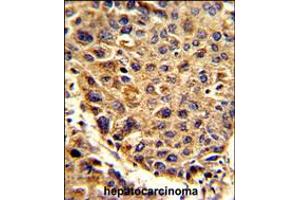 Formalin-fixed and paraffin-embedded human hepatocarcinoma reacted with SPCS3 Antibody , which was peroxidase-conjugated to the secondary antibody, followed by DAB staining. (SPCS3 抗体  (C-Term))