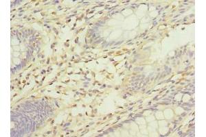 Immunohistochemistry of paraffin-embedded human colon cancer using ABIN7175519 at dilution of 1:100