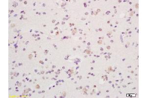 Formalin-fixed and paraffin embedded human glioma tissue labeled with Anti phospho-Dnmt1(Ser154) Polyclonal Antibody, Unconjugated (ABIN757717) at 1:200 followed by conjugation to the secondary antibody and DAB staining (DNMT1 抗体  (pSer154))