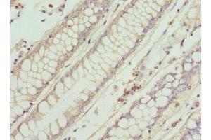 Immunohistochemistry of paraffin-embedded human colon cancer using ABIN7156584 at dilution of 1:100 (IFNB1 抗体  (AA 22-187))