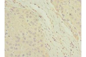 Immunohistochemistry of paraffin-embedded human liver cancer using ABIN7154846 at dilution of 1:100 (HAND2 抗体  (AA 1-217))