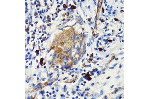 Immunohistochemistry of paraffin-embedded human lung cancer using Argonaute-2 antibody (ABIN7265671) at dilution of 1:100 (40x lens). (AGO2 抗体)