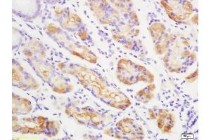 Formalin-fixed and paraffin embedded human gastric carcinoma labeled with Anti-Anei-ATX/Autotaxin Polyclonal Antibody, Unconjugated (ABIN740265) at 1:200 followed by conjugation to the secondary antibody (ENPP2 抗体  (AA 601-700))
