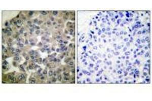 Immunohistochemical analysis of paraffin-embedded human breast carcinoma tissue using PLCG1 (Ab-771) antibody. (Phospholipase C gamma 1 抗体  (Tyr771))
