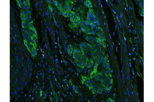 IF analysis of HLA-C using anti-HLA-C antibody (ABIN3043843) HLA-C was detected in paraffin-embedded section of human oesophagus squama cancer tissues.