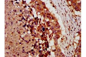 IHC image of ABIN7149298 diluted at 1:300 and staining in paraffin-embedded human lung cancer performed on a Leica BondTM system. (CRLF1 抗体  (AA 318-422))