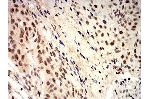 Immunohistochemical analysis of paraffin-embedded esophageal cancer tissues using ROP1 mouse mAb with DAB staining. (ROP1 (AA 42-183) 抗体)
