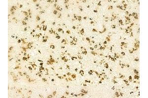 ABIN6261227 and ABIN6268967 at 1/100 staining human melanoma by IHC-P. (DAXX 抗体  (C-Term))