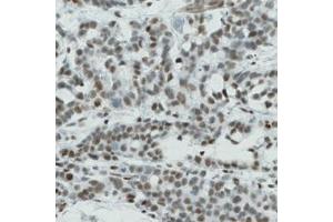 Immunohistochemical staining (Formalin-fixed paraffin-embedded sections) of human stomach cancer with CTCF monoclonal antibody, clone CL0305  shows nuclear immunoreactivity in tumor cells. (CTCF 抗体)