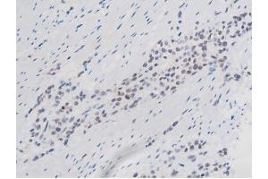 ABIN6267508 at 1/200 staining Human bladder cancer tissue sections by IHC-P. (STAT1 抗体  (pSer727))