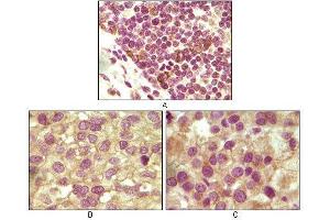 Immunohistochemical analysis of paraffin-embedded human lymphoid (A), ovary tumor (B) and testicle tumor (C) tissues using INHA mouse mAb with DAB staining. (Inhibin alpha 抗体)