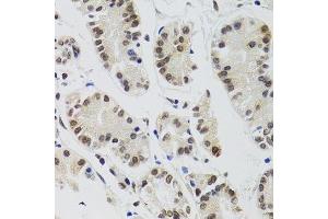 Immunohistochemistry of paraffin-embedded human gastric cancer using EDF1 antibody.